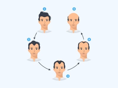 Eine Visualisierung der Phasen der m&auml;nnlichen adnrogenetischen Alopezie.