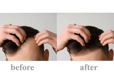 Ein Bild mit den Ergebnissen einer Haartransplantation