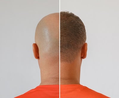 Ein Mann mit Glatze vor und nach der Behandlung