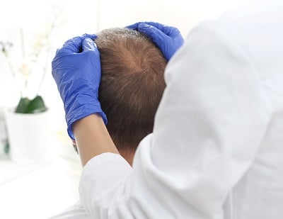 Ein Mann, der unter Haarausfall leidet, wird von einer &Auml;rztin untersucht.