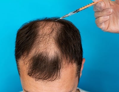 Ein Arzt mit einer Spritze, der einem Mann mit Alopezie eine PRP-Injektion verabreicht.