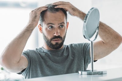 Ein Mann, der unter hormonellem Haarausfall leidet.