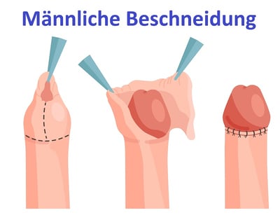 Ein Vektorbild der m&auml;nnlichen Beschneidung
