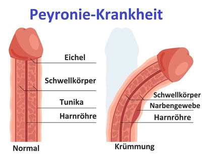 Schematische Darstellung eines normalen Penis und einer Penisverkr&uuml;mmung